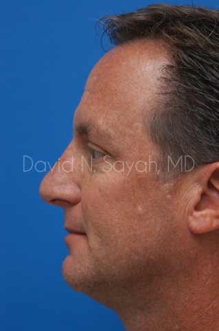 Rhinoplasty Before and After | Sayah Institute