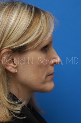Rhinoplasty Before and After | Sayah Institute