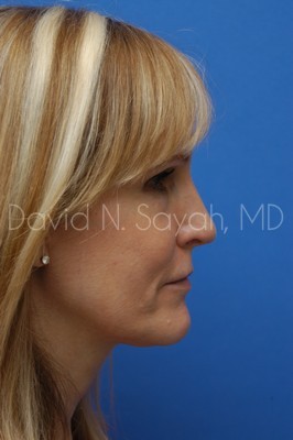 Rhinoplasty Before and After | Sayah Institute