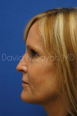 Rhinoplasty Before and After | Sayah Institute