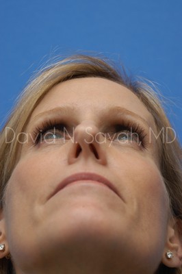 Rhinoplasty Before and After | Sayah Institute