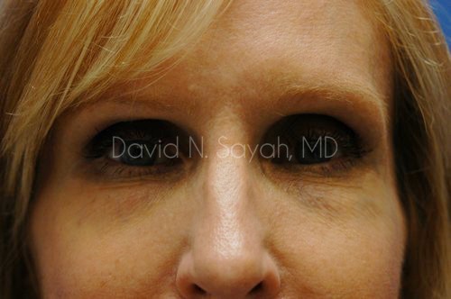 Rhinoplasty Before and After | Sayah Institute