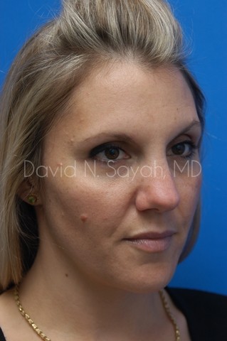 Rhinoplasty Before and After | Sayah Institute