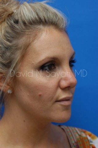 Rhinoplasty Before and After | Sayah Institute