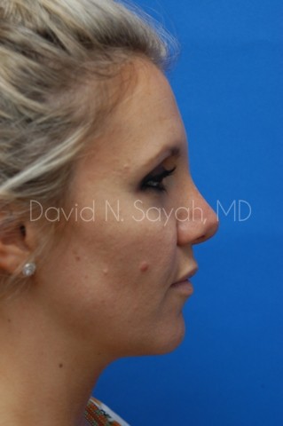 Rhinoplasty Before and After | Sayah Institute