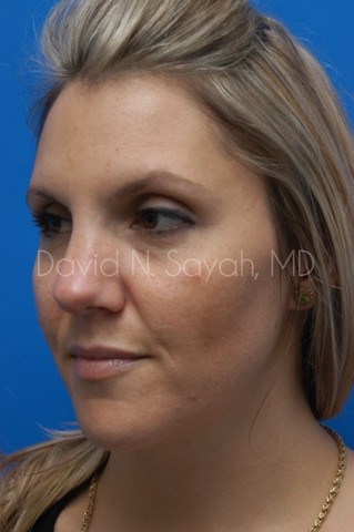 Rhinoplasty Before and After | Sayah Institute