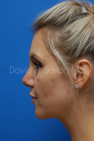 Rhinoplasty Before and After | Sayah Institute