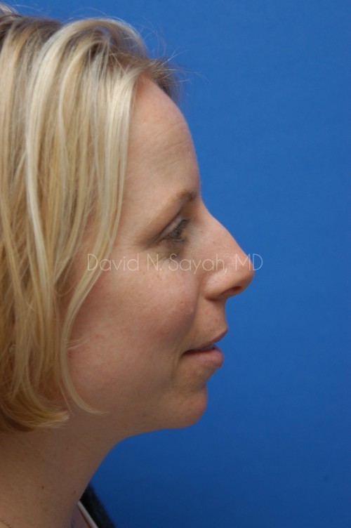 Rhinoplasty Before and After | Sayah Institute