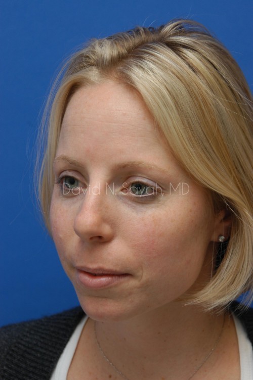 Rhinoplasty Before and After | Sayah Institute