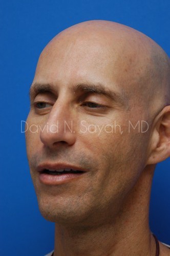Rhinoplasty Before and After | Sayah Institute