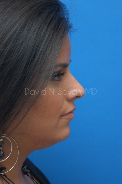 Rhinoplasty Before and After | Sayah Institute