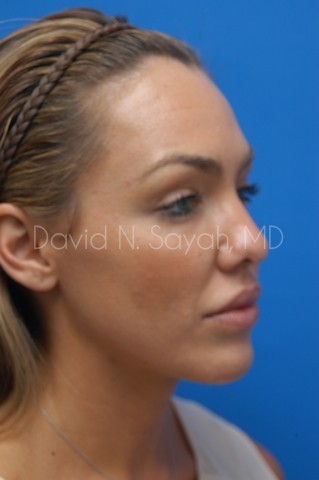 Rhinoplasty Before and After | Sayah Institute