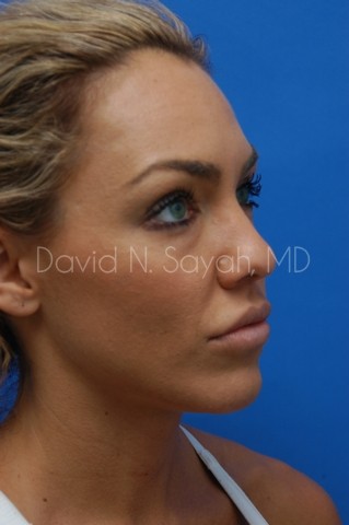 Rhinoplasty Before and After | Sayah Institute
