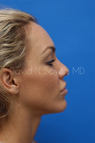 Rhinoplasty Before and After | Sayah Institute