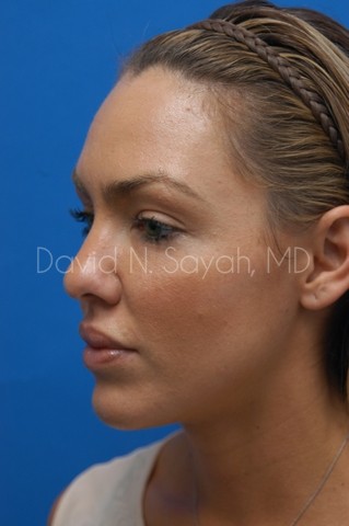 Rhinoplasty Before and After | Sayah Institute
