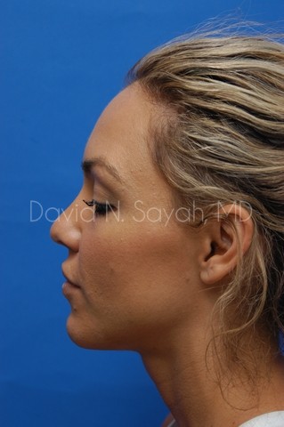 Rhinoplasty Before and After | Sayah Institute