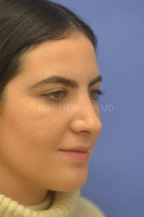 Rhinoplasty Before and After | Sayah Institute