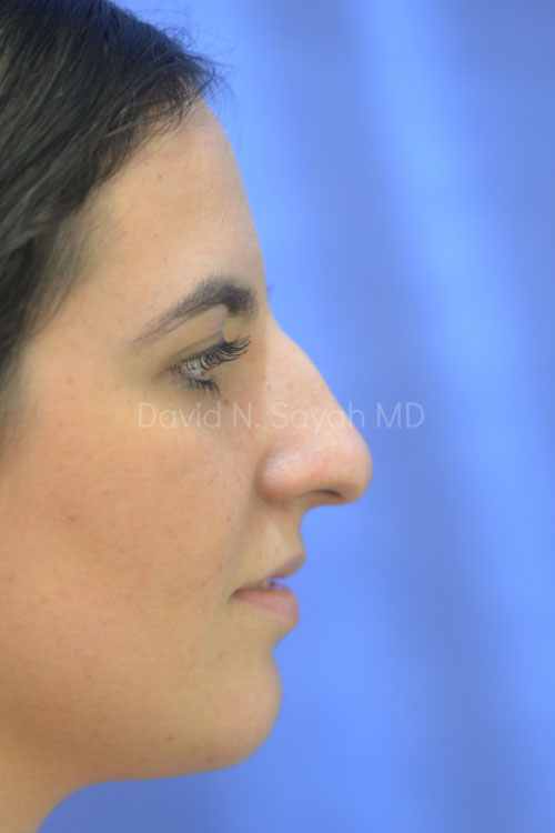 Rhinoplasty Before and After | Sayah Institute