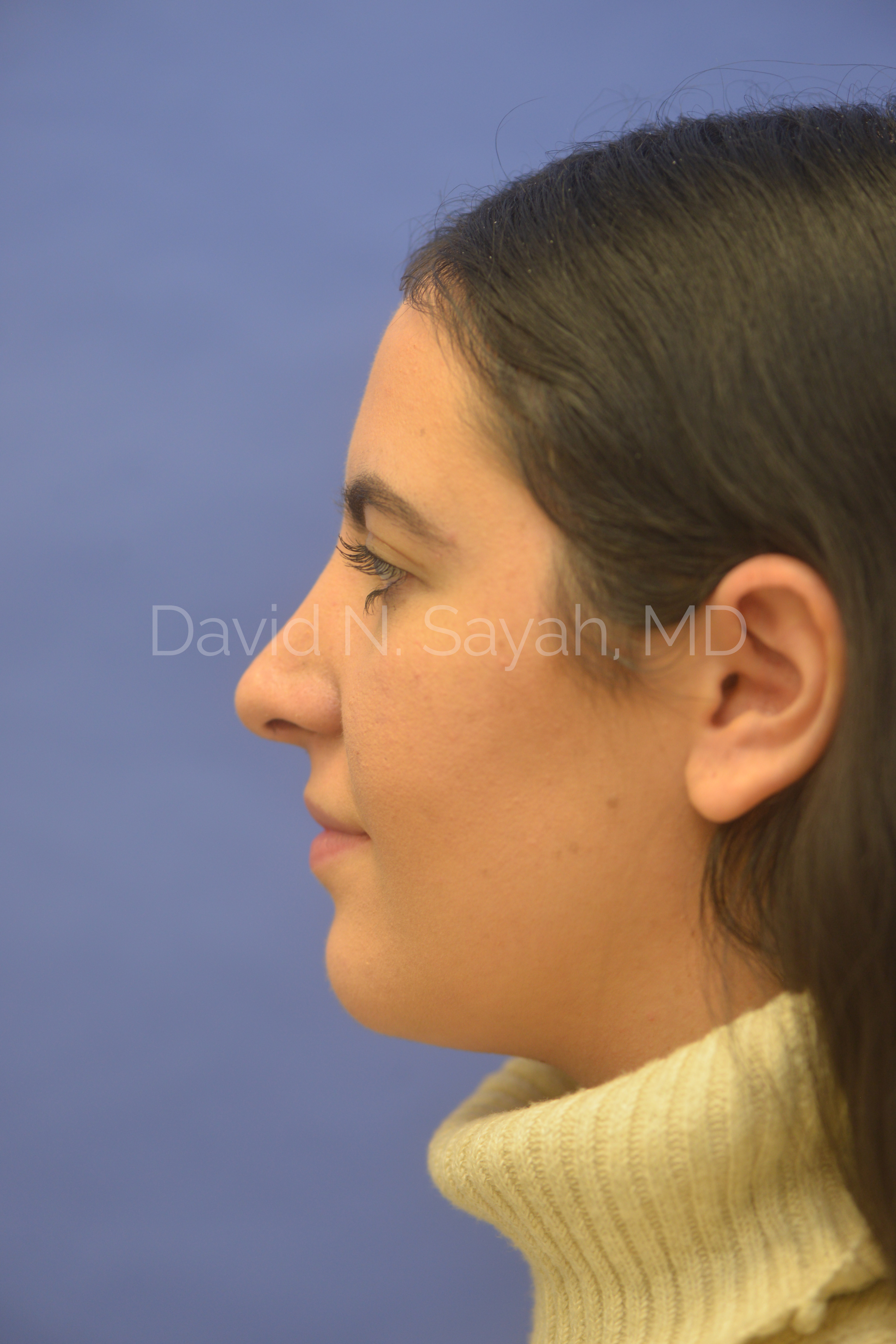 Rhinoplasty Before and After | Sayah Institute