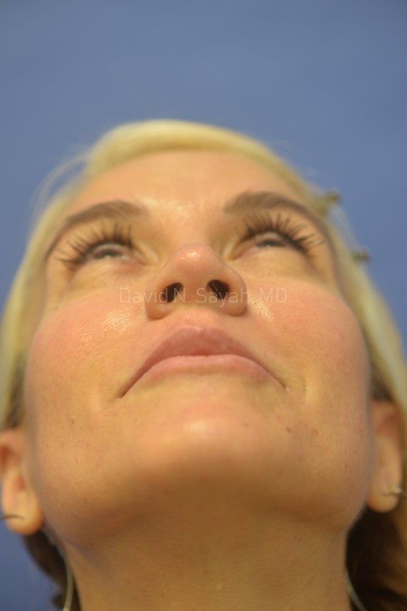 Rhinoplasty Before and After | Sayah Institute