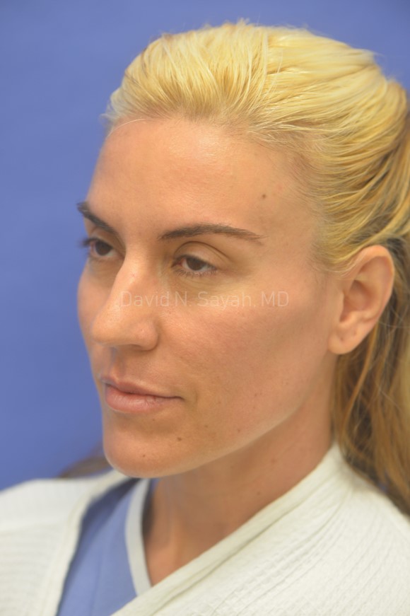 Rhinoplasty Before and After | Sayah Institute