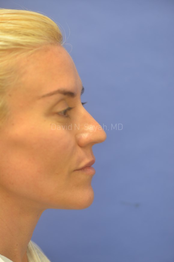 Rhinoplasty Before and After | Sayah Institute