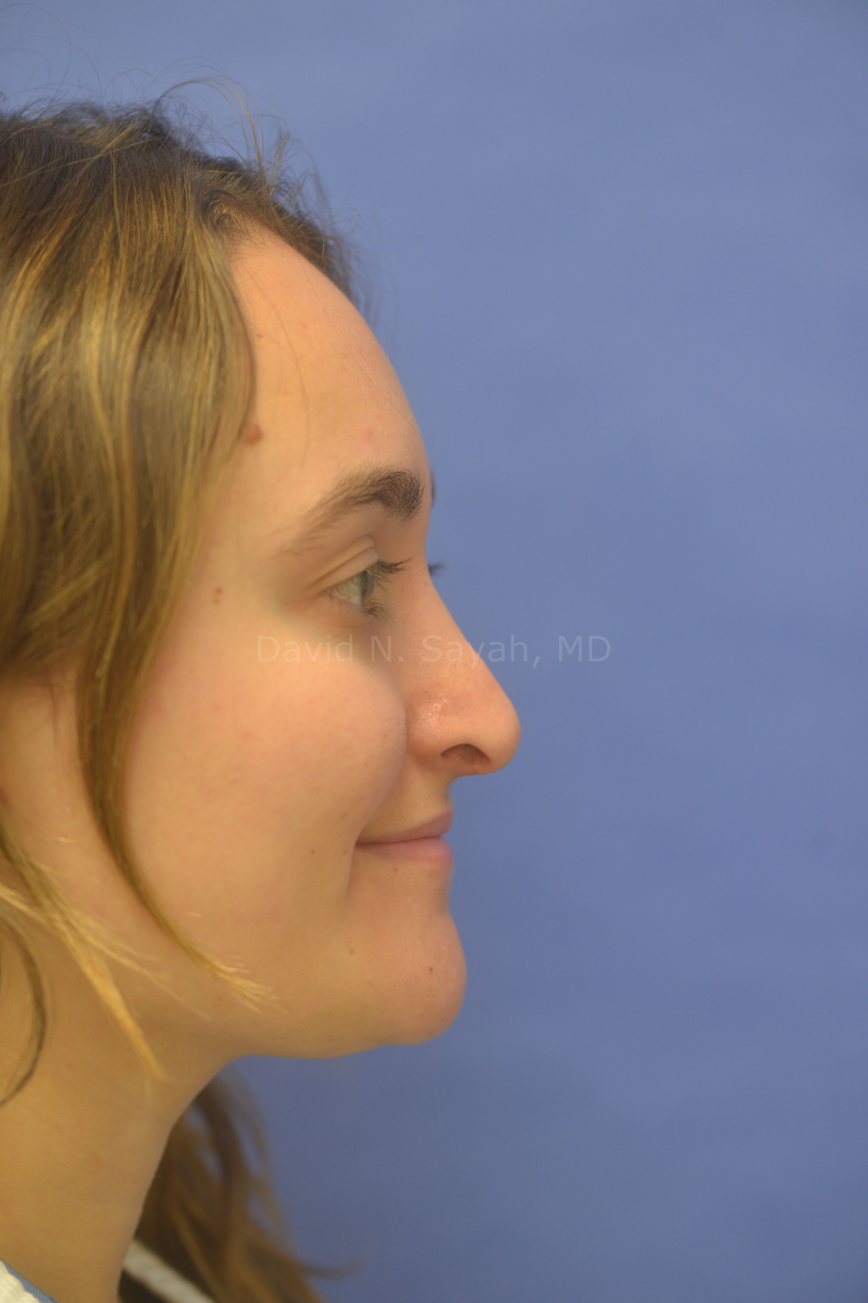 Rhinoplasty Before and After | Sayah Institute