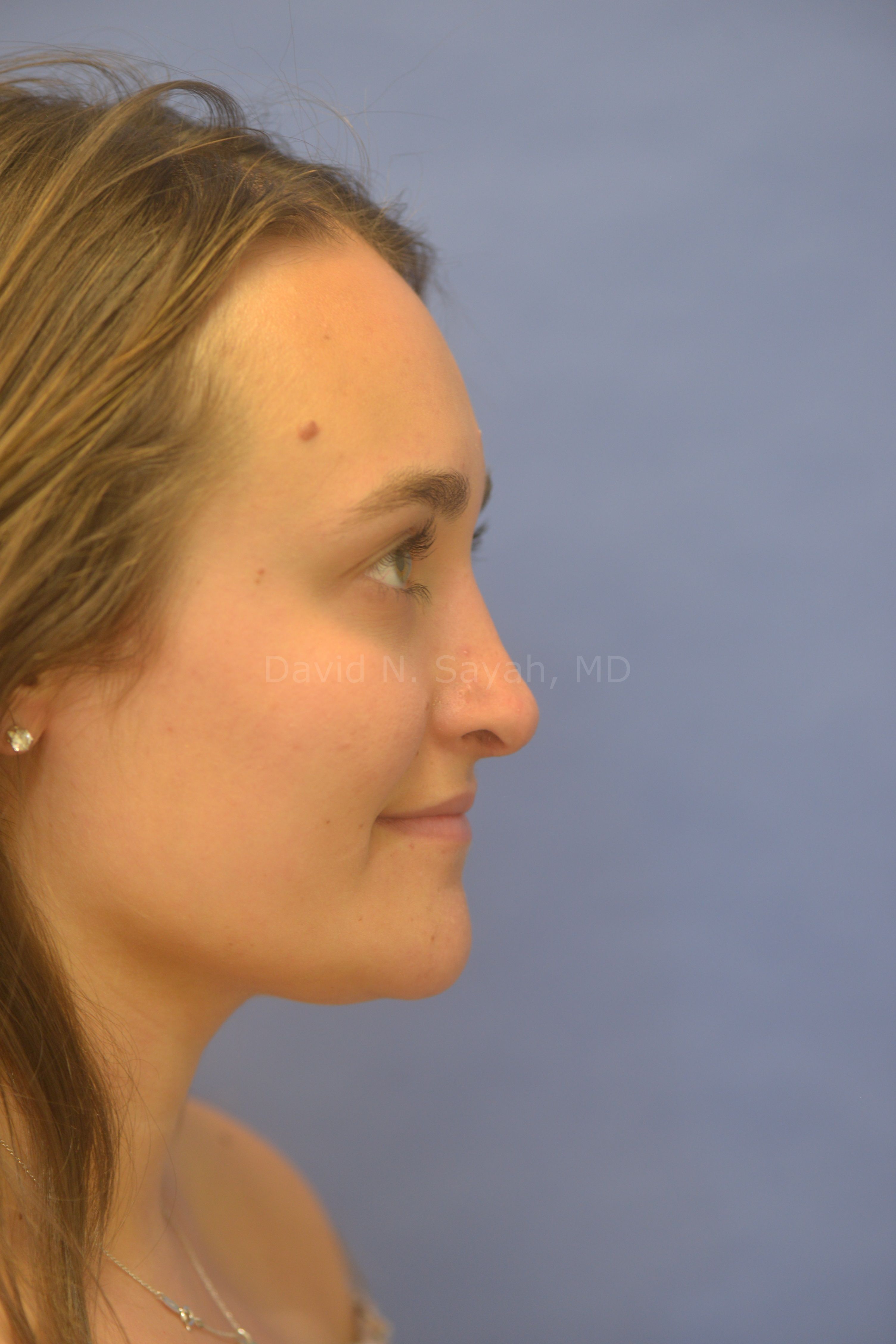 Rhinoplasty Before and After | Sayah Institute