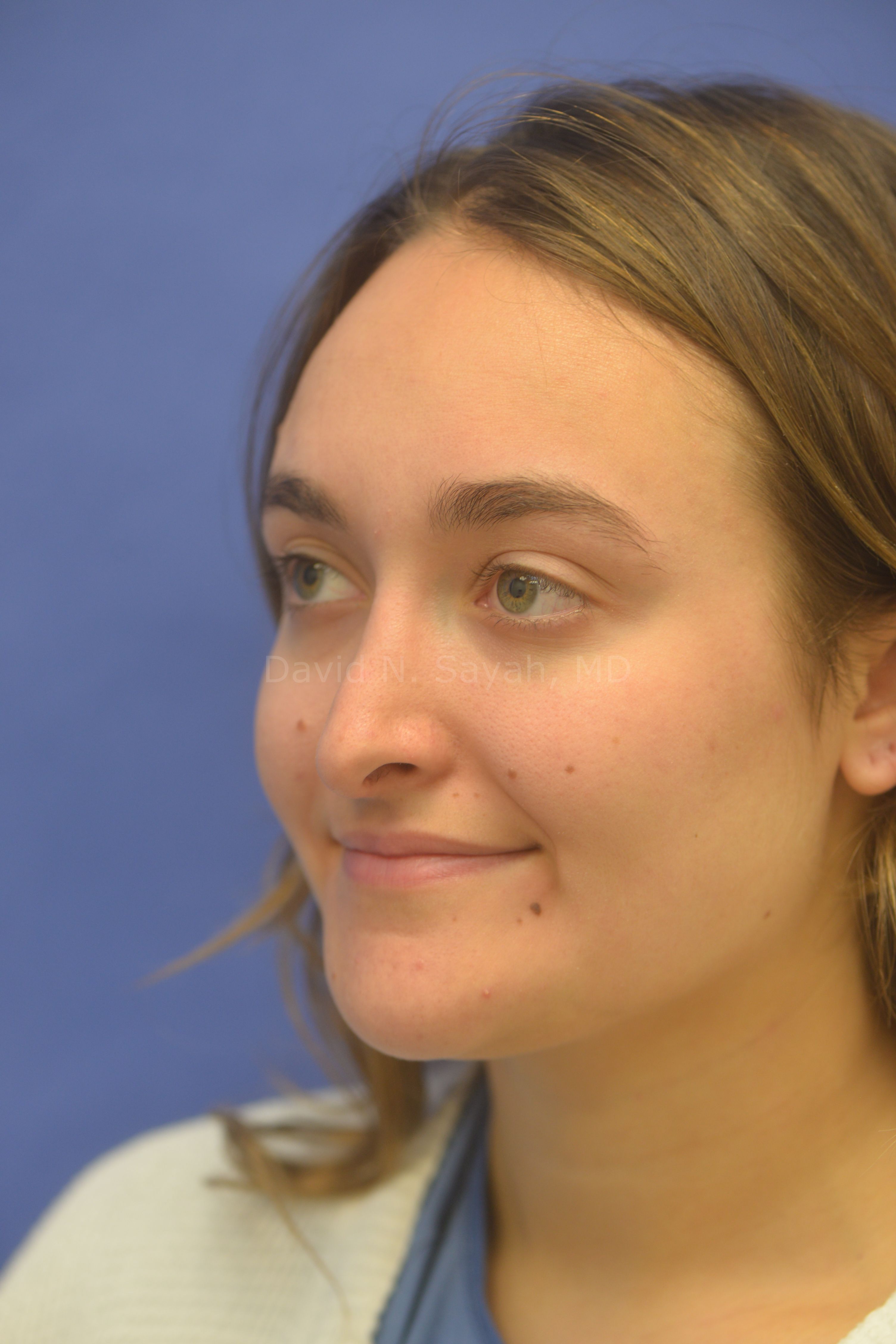 Rhinoplasty Before and After | Sayah Institute