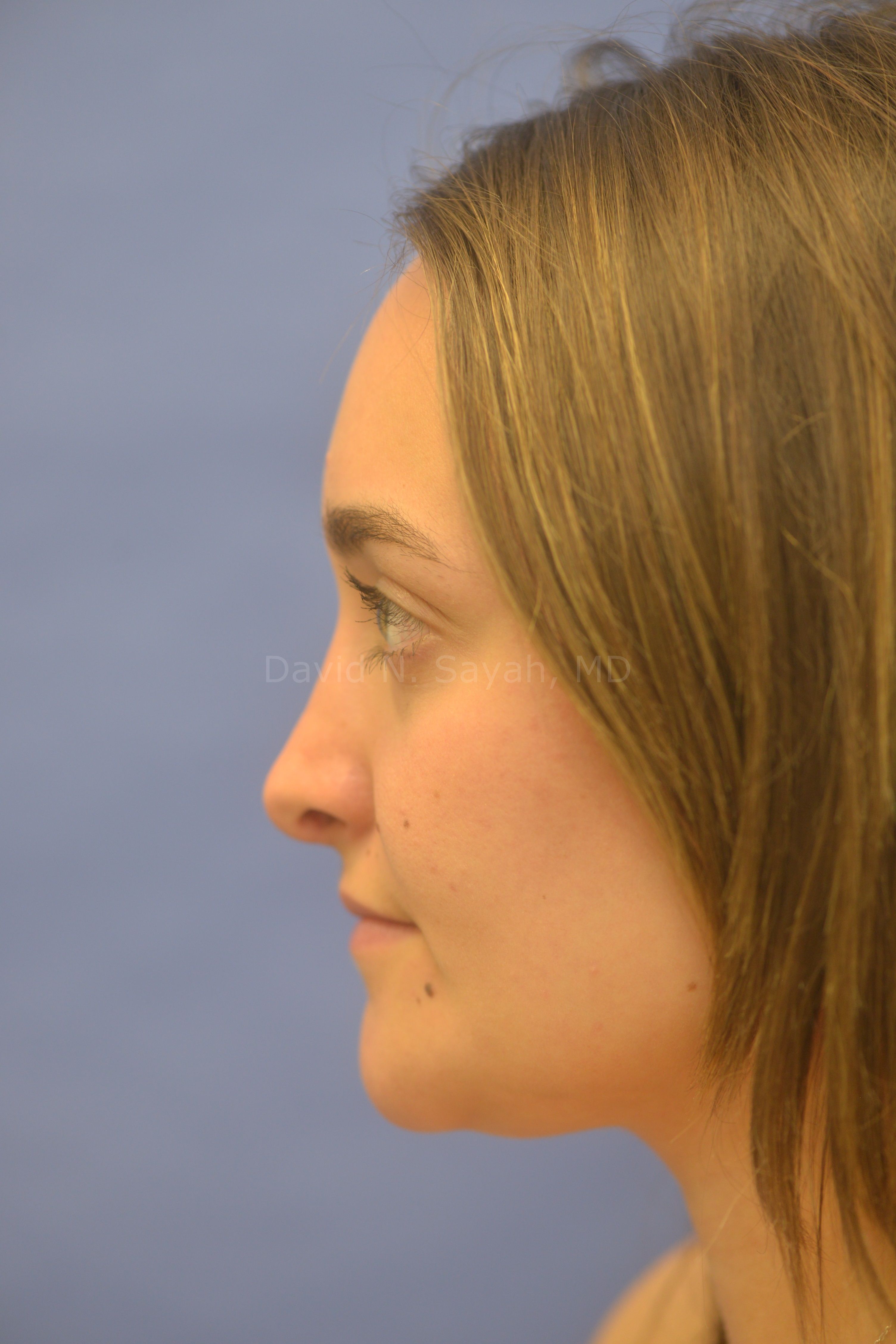 Rhinoplasty Before and After | Sayah Institute