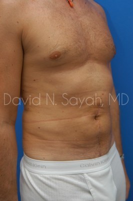 Scar Revision Body Before and After | Sayah Institute