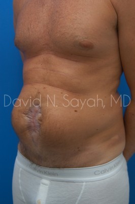 Scar Revision Body Before and After | Sayah Institute