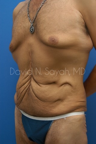Scar Revision Body Before and After | Sayah Institute