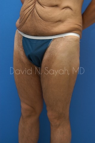 Scar Revision Body Before and After | Sayah Institute