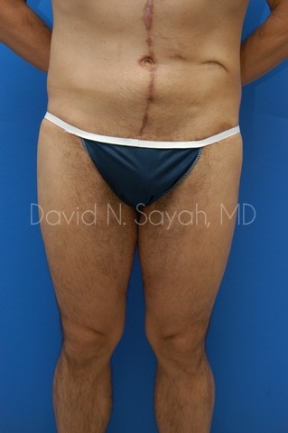Scar Revision Body Before and After | Sayah Institute