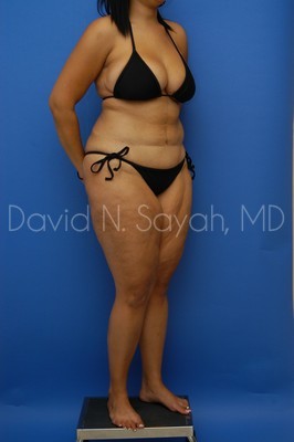 Thigh Lift Before and After | Sayah Institute