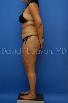 Thigh Lift Before and After | Sayah Institute