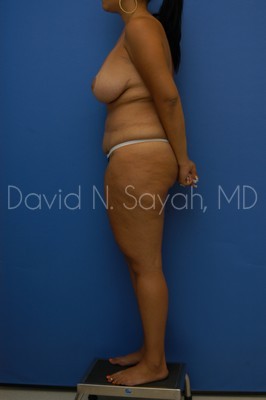 Thigh Lift Before and After | Sayah Institute