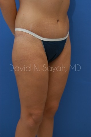 Thigh Lift Before and After | Sayah Institute