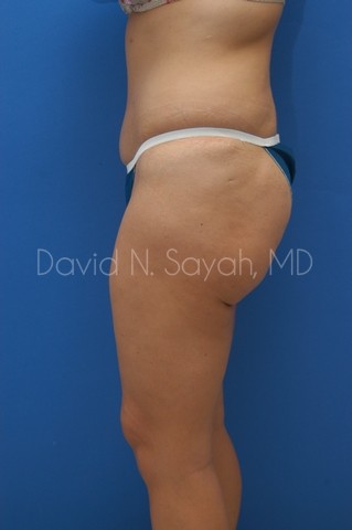 Thigh Lift Before and After | Sayah Institute