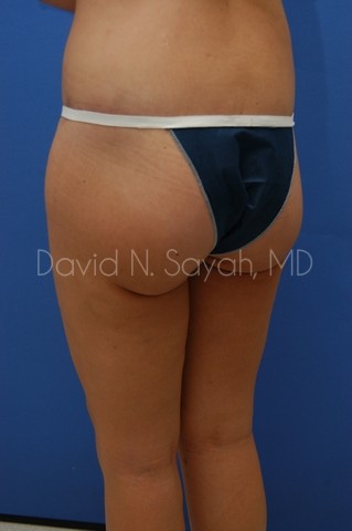 Thigh Lift Before and After | Sayah Institute