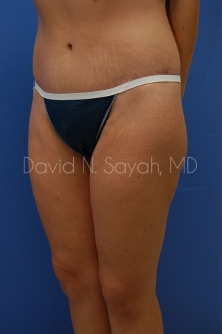 Thigh Lift Before and After | Sayah Institute