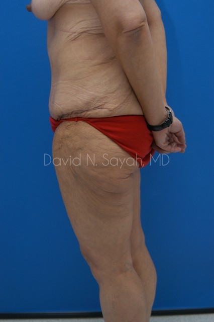 Thigh Lift Before and After | Sayah Institute