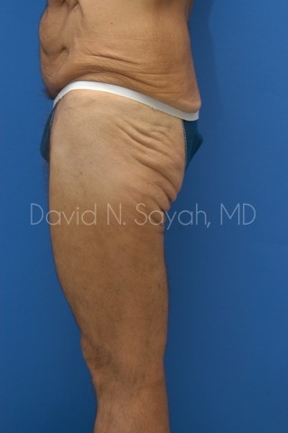 Thigh Lift Before and After | Sayah Institute