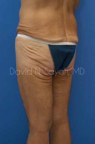 Thigh Lift Before and After | Sayah Institute