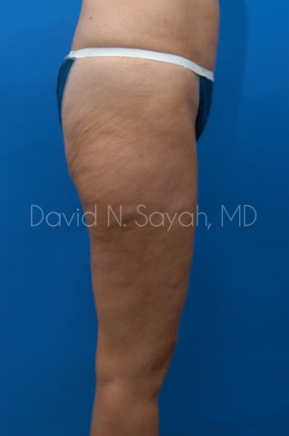 Thigh Lift Before and After | Sayah Institute