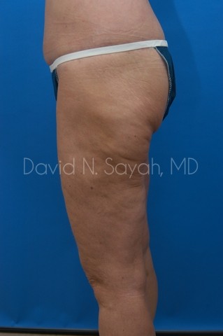 Thigh Lift Before and After | Sayah Institute
