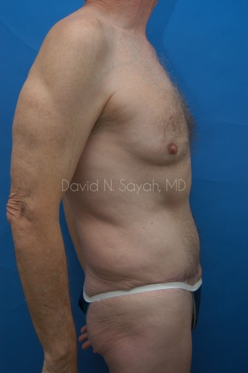 Tummy Tuck Before and After | Sayah Institute