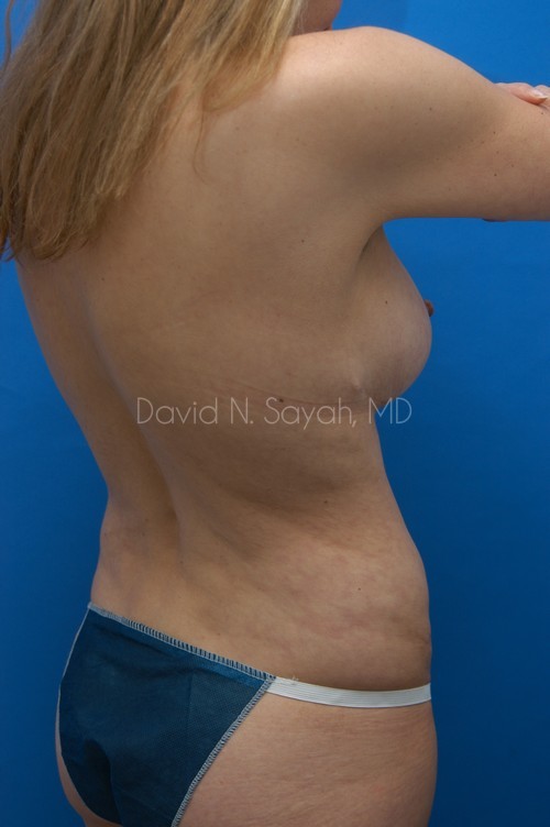 Tummy Tuck Before and After | Sayah Institute