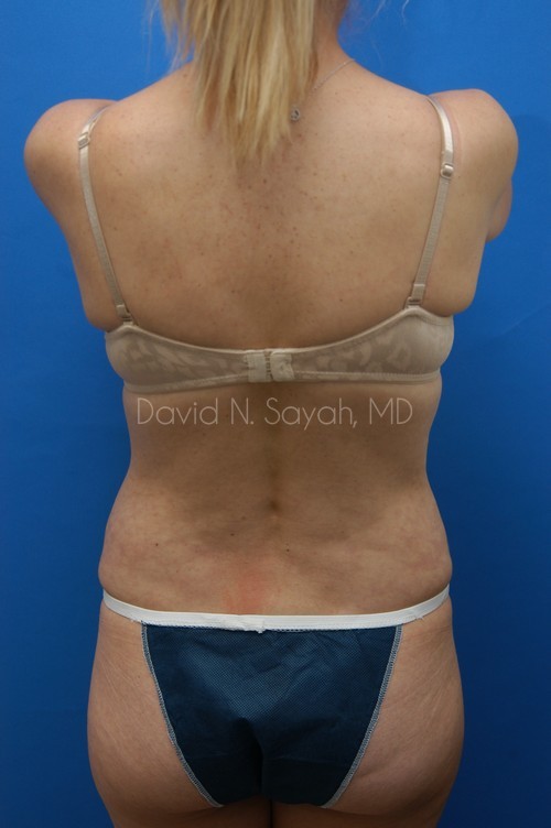 Tummy Tuck Before and After | Sayah Institute